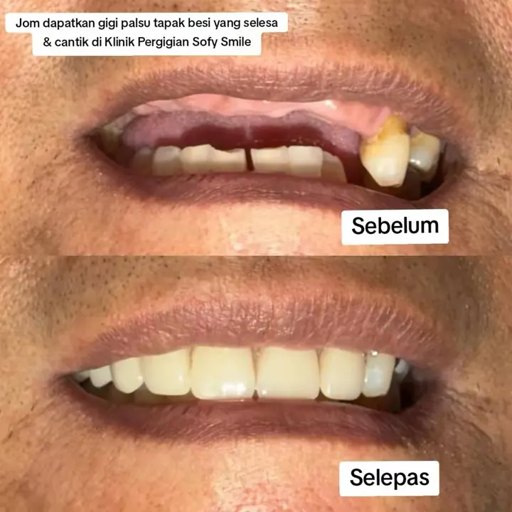 Sebelum dan selepas gigi palsu, kes pesakit Sofy Smile